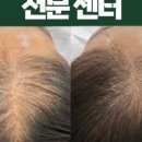 렛미인X모리바이브두피탈모