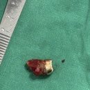 튼튼한연세치과의원 | [아산 연세원치과]만성 치근단 염증과 골밀도: "딱딱하게 굳은 뼈(경화골)와의 사투"