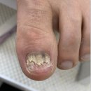 범계무좀발톱 미엘네일 페디크루 안양점에서 해결