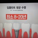 임플란트 평균 수명 이미지