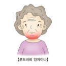 루드비히 안자이나 (Ludwig's Angina) 이미지