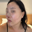 부산피부과추천 쥬베룩볼륨후기 옆볼꺼짐 내돈내산
