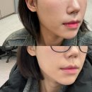 포레성형외과 | 팔자주름 시술 압구정 피부과 포레스트리프팅 일주일 후기