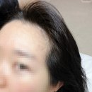 SMP 두피문신 후기｜영등포 탈모 고민으로 모다스튜디오 방문