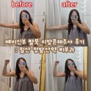 (주)게델와이 | 팔뚝 지방분해주사 효과 일산 정발산역피부과 지분주 4회차 솔직후기