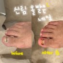 발건강 | 신림 내성발톱 아빠 무좀발톱 관리 올발은네일 후기 | 발건강 진짜중요해