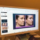 분당-300 | 분당 정자동 피부과 리프팅 써마지 FLX 300샷 후기