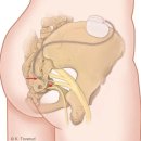 과민성 방광 Overactive Bladder Syndrome--＞ Sacral nerve stimulation 문치연 치료탐구! 이미지