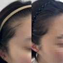 글로벌팜코리아(주) | 서울,논현 _ 블랙카운티 / 강남 헤어라인 두피문신 잘하는곳 블랙카운티추천!