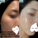 오투성형외과 | 압구정 줄기세포피부주사 ㅇㅇㅌ 성형외과에서 MCT자가혈엑소좀치료 다운타임 제로 다음날 출근 단골의...