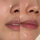 해운대에스테틱 | 부산 해운대 에스테틱 시즈너블 여드름 피부관리 후기