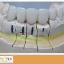 이천치과기공소 이미지