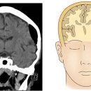 기뇌증[Pneumocephalus] 이미지