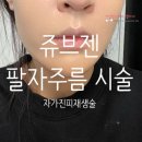 (주)엘리샤 | 쥬브젠 2주지난 후기 팔자주름 효과 점점 나타나고 있네요