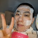 서울 명동피부과 여드름흉터 치료 srs 패키지 레이저 4달 후기 내돈내산