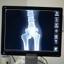 밸런스정형외과의원 | 걷다 보니 삐끗한 내 몸 구원템 발견!