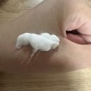 가산한의원 | 가산 피부과 한의원 새살침 1회차 치료 후기, 패인 흉터 차오르는 리얼 변화