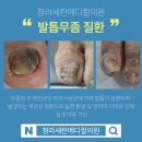 세란의원 | 발톱무좀 스케일링 후기 ㅣ 청라 세란메디컬의원