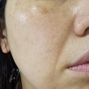 하이드로퀴논 크림 성분 약국 후기 사용법