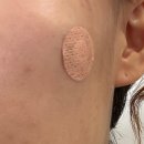 서울성형외과의원 | [표피낭 제거 후기] 오체안 성형외과의원 신사