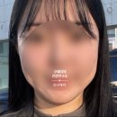 내돈내산 포텐자 쥬베룩 2회차 후기 및 울쎄라 프라임 효과