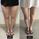 전신 지방분해주사 1회차 솔직 후기
