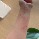 자하생식원 | 피부, 아토피 피부 자가 치유 과정 기록_자하생식 효소 찜질(효소 찜질 2개월 후기), 탈스테로이드 과정