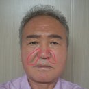 효도선물! 아빠 팔자주름 펴드리기 ( 더올린의원 수원점 )