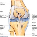 ACL reconstruction (전방인대 재건술) 그림 이미지