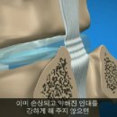 [허리디스크]허리디스크,허리 보조 기구의 사용은 괜찮을까 ? 이미지