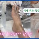 레푸스 가격 및 비용, 실제 후기 모음 (Feat. 레푸스 내성발톱 가격)
