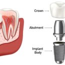손영진치과의원 | 뼈이식 없이 성공한 무통 임플란트, 구미 옥계동 손영진치과 환자 후기