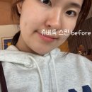 [인천피부과] 송도 인천대입구역 쥬베룩 스킨부스터 리얼후기