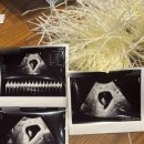 르샘여성의원 | 임신 7주 3일차 | 증상 사라짐, 여의도 르샘여성의원 초음파, 임밍아웃