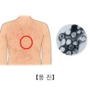 풍진 이미지