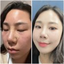 한남동피부과 트리필프로 올리디아마요 스킨부스터 후기