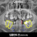 플란부평후기 난이도 높은 40대 남자 환자의 전체임플란트