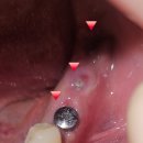 한사랑여성의원 | 임플란트 3주차(뼈이식+식립 한번에 진행) 치과보험 강추