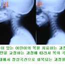 측만증을 치료하는 과정에서 거북목을 교정한 예 이미지