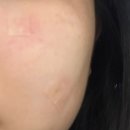 블랑쥬의원 | 대구블랑쥬의원 점빼기(점제거)내돈내산 후기 / 동성로 점 빼는곳