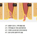 ■ 치질(痔疾. 치핵 치루 치열)의 원인 및 예방. 치료 이미지