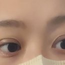 여름에 쌍수한 여자 1년 후 후기