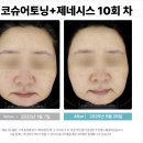 강남고운의원 | 기미 잡티 레이저 후기 기미색소침착 피코슈어 &amp; 제네시스 꿀조합