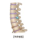 척추병증 (Spondylopathies) 이미지