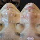 행신 피부관리 꿀벌스킨앤바디에서 블랙헤드 모공세척관리 후기