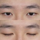 예쁨의정석의원 | 남자 비절개눈매교정, 느끼함 없이 또렷해지는 무쌍 속쌍의 정석