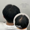 남성생활교육 | 은평구 남성두피문신 후기｜30~40대 정수리 탈모, 왜 다들 이 선택을 했을까