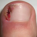 오름정형외과의원 | 내향성 발톱, 방치하면 안 되는 이유 - 미금본닥터정형외과 수부외과 전문의가 알려드립니다