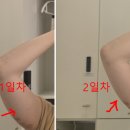 강남 팔뚝지방분해주사 가격 효과 팔뚝살 제거 후기
