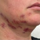 동인의원 | 신사동인모드, 리프팅 부작용은 왜 사람마다 다를까? 멍·붓기 기간 현실 기준